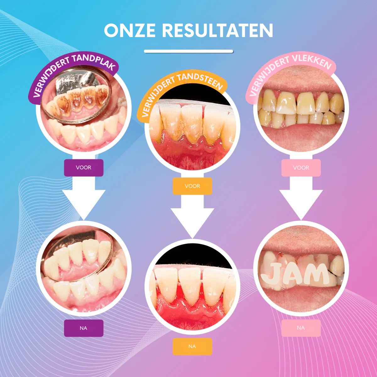 GlowSmile™ Pro - Ultrasone Tandenreiniger