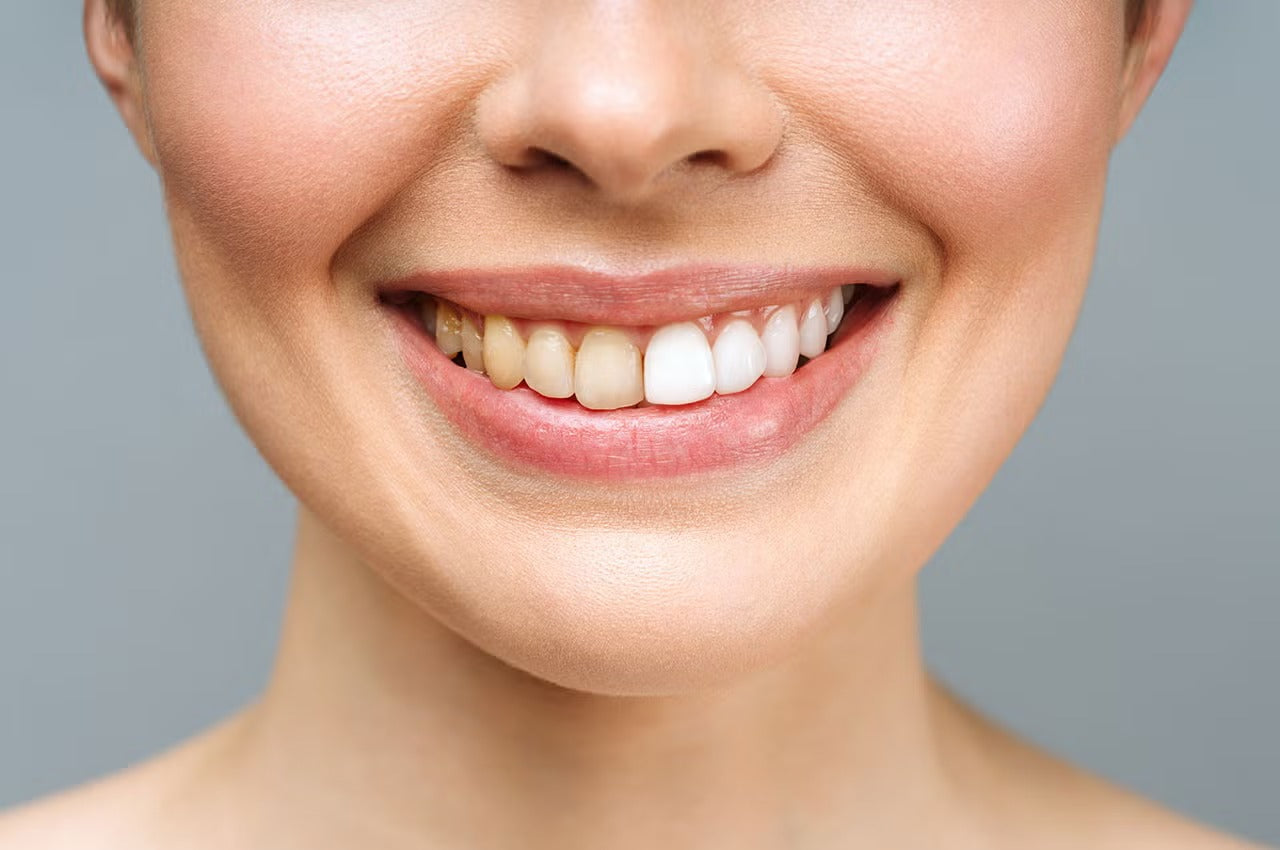 Tooth Discoloration: Causes and How to Fix Stained Teeth at Home