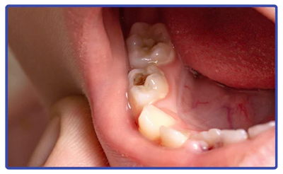 Close-up kindergebit met gaatjes