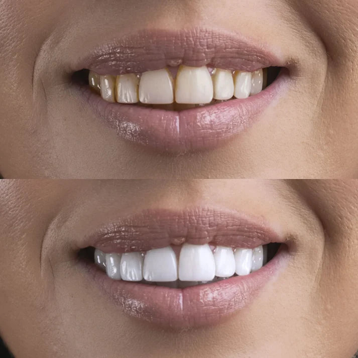GlowSmile™ Pro - Ultrasone Tandenreiniger
